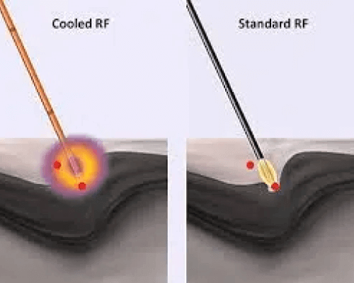 Cooled RF