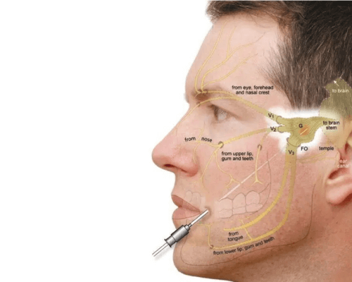 Trigeminal RF