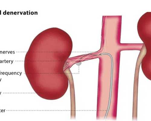 Nerve Denervation