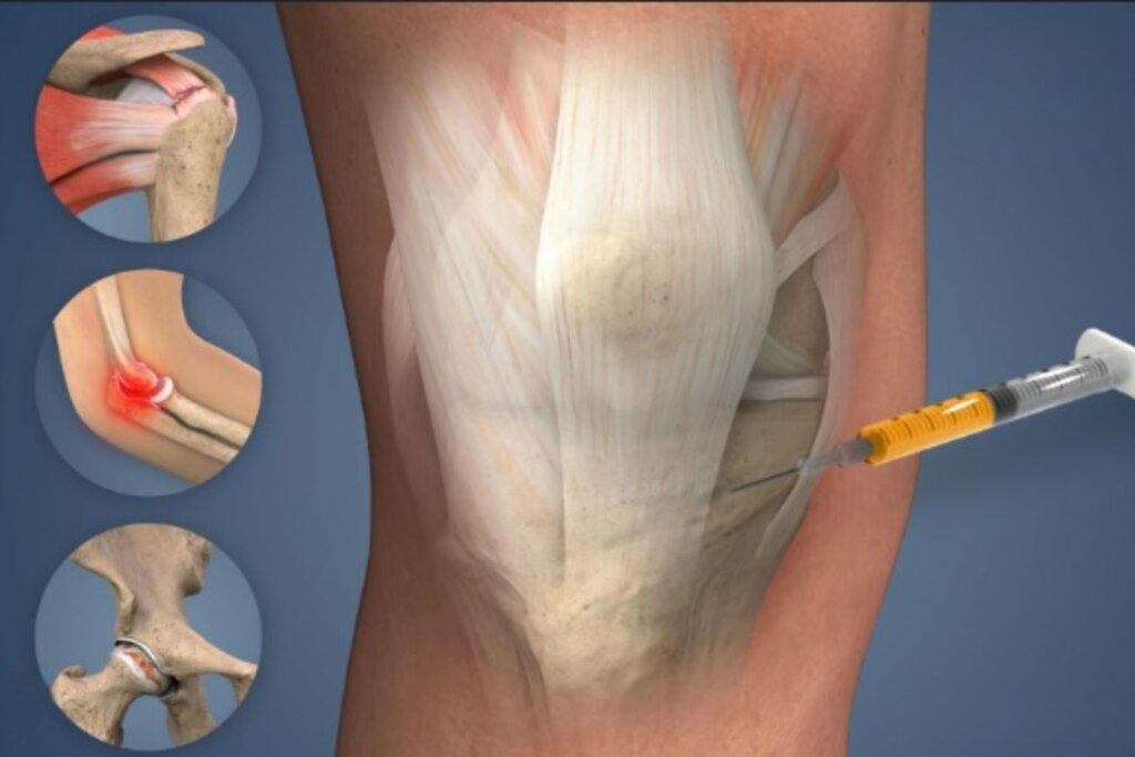 Doctor performing Platelet-Rich Plasma (PRP) Therapy for natural tissue healing and pain relief at IBAP Clinics Hyderabad